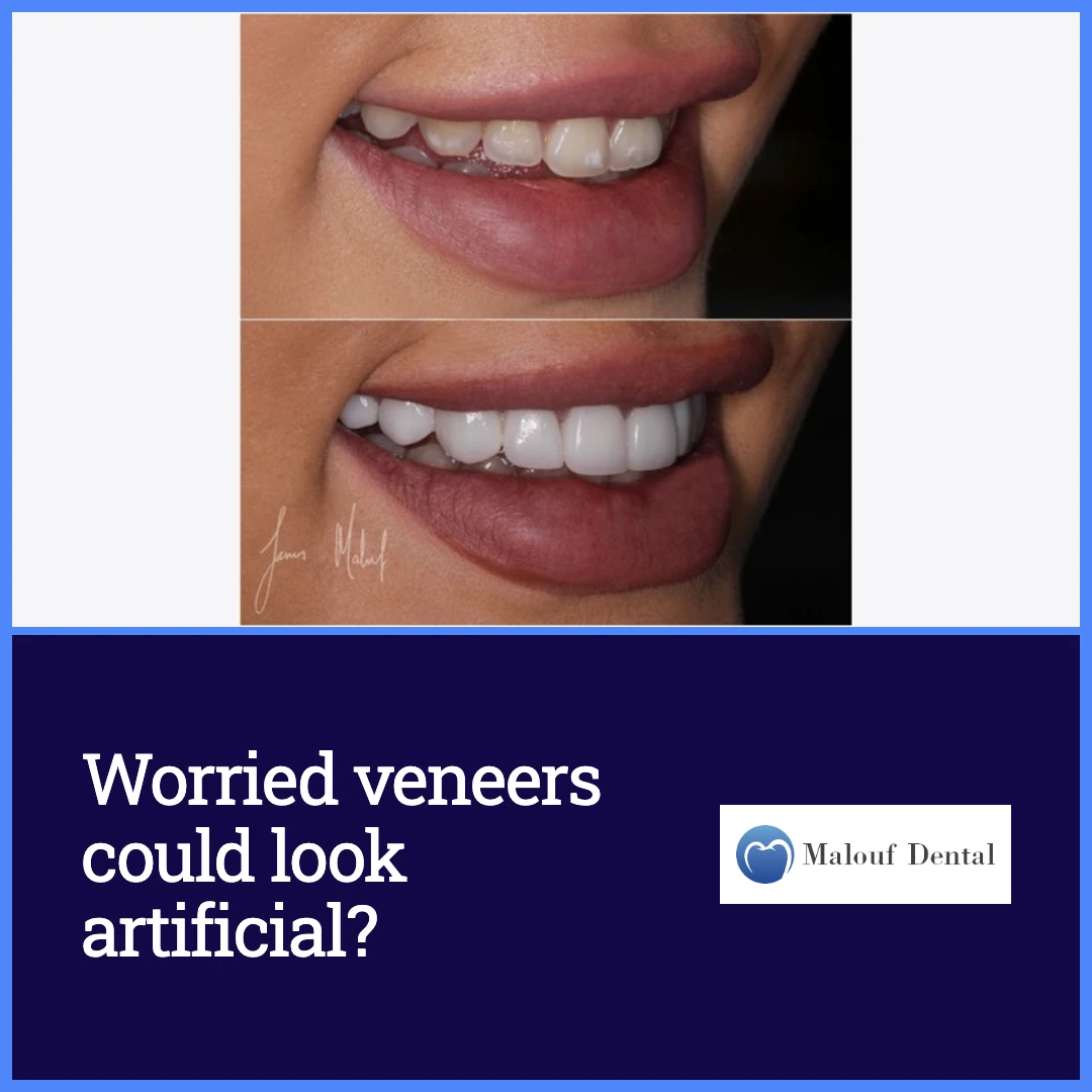 Worried veneers could look artificial? ad creative