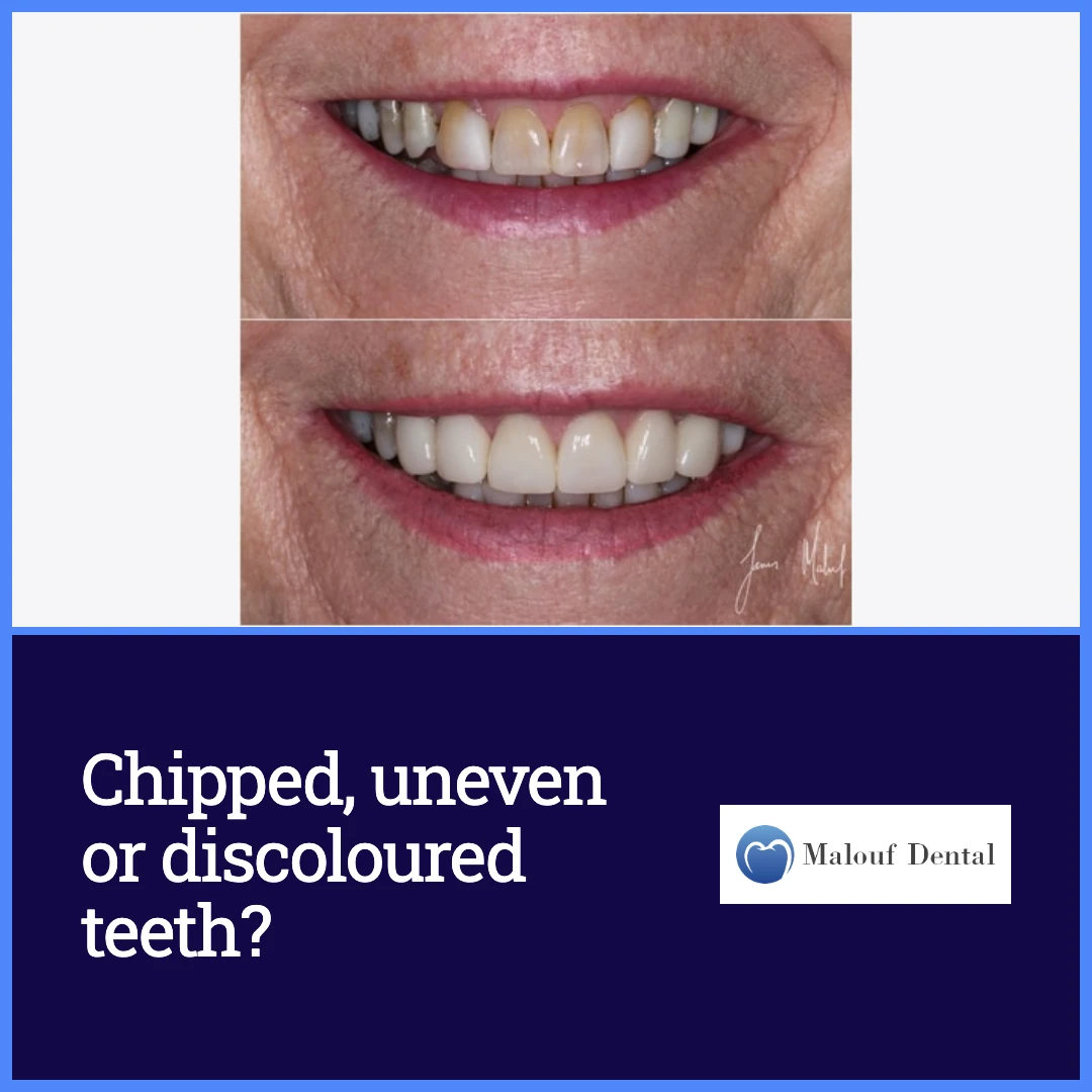 Chipped, uneven or discoloured teeth? ad creative